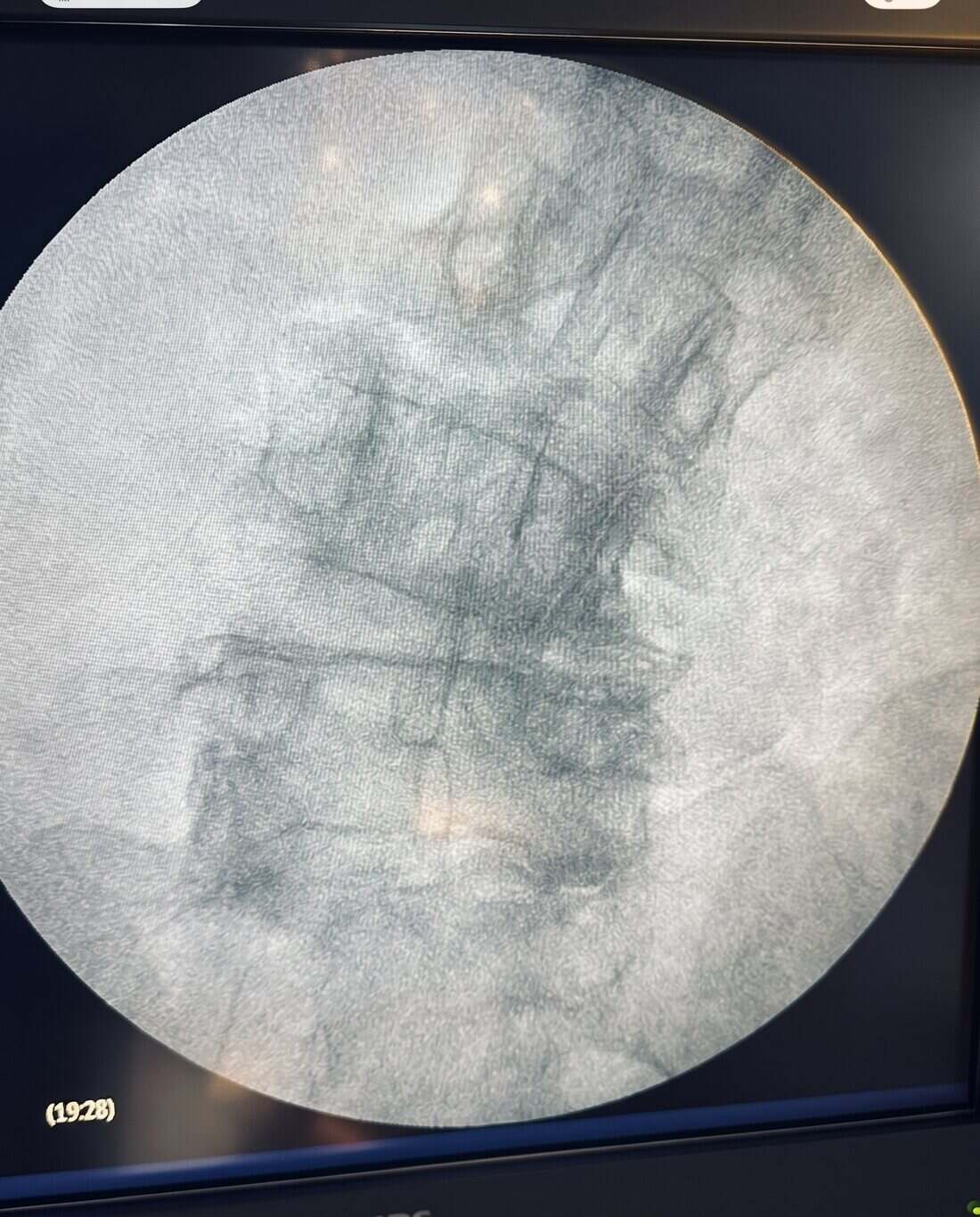 Imagen de escopia (radioscopia) de la parte baja de la columna durante un procedimiento en Clínica Dolentia, el tipo de guía por imagen que permite llegar con precisión a la base de la columna y al ganglio impar