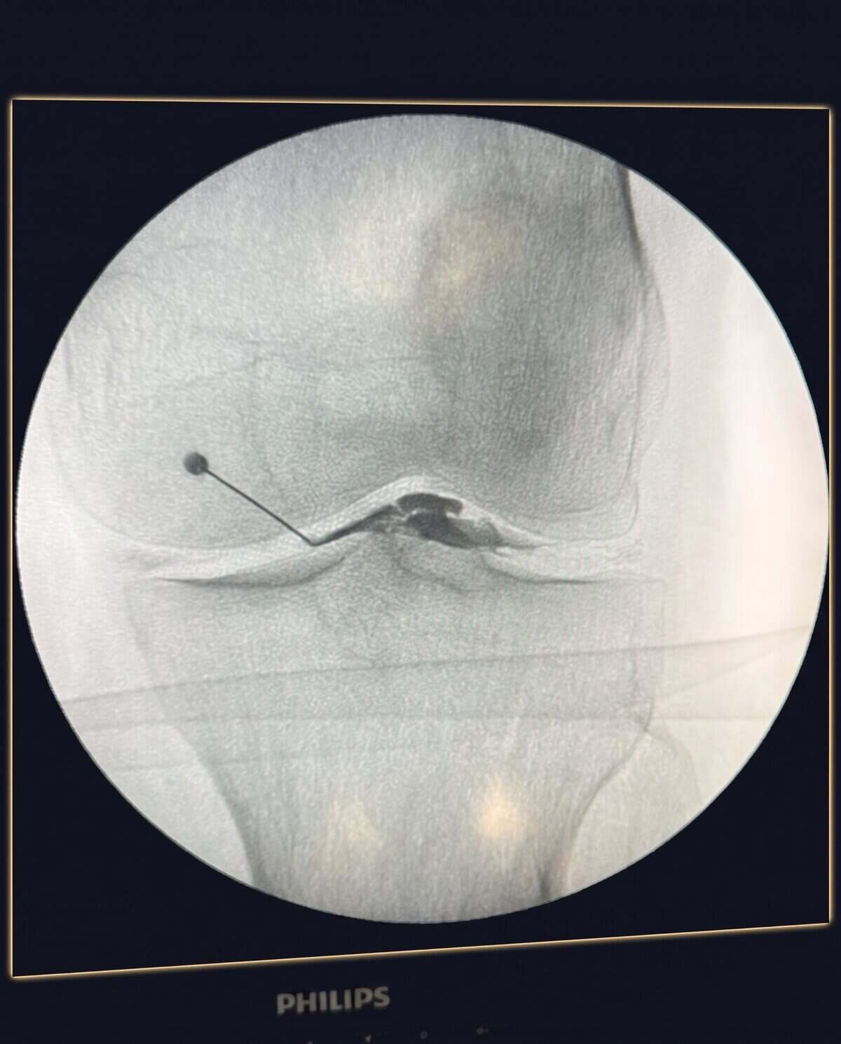Imagen de escopia (radioscopia) de una rodilla durante una infiltración guiada en Clínica Dolentia: la aguja alcanza con precisión el interior de la articulación